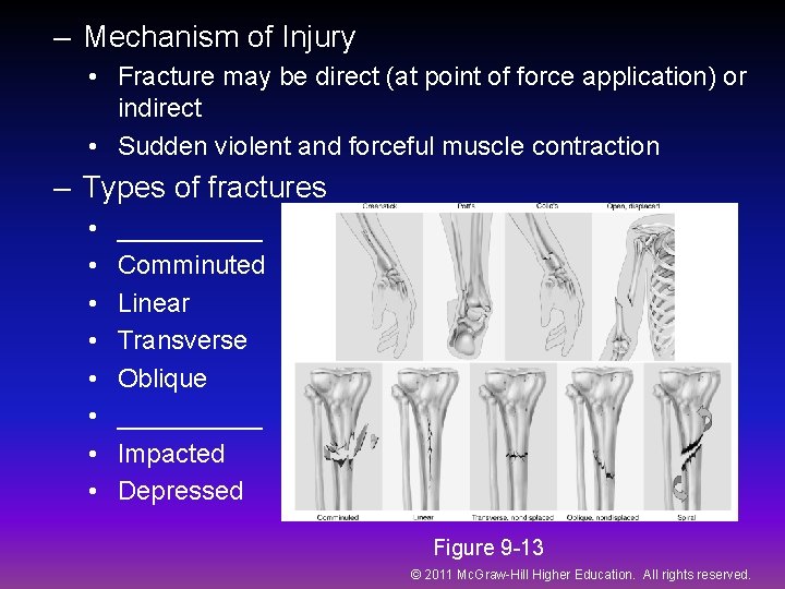 – Mechanism of Injury • Fracture may be direct (at point of force application)