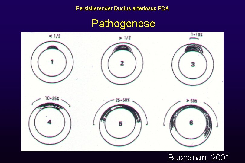 Persistierender Ductus arteriosus PDA Pathogenese Buchanan, 2001 