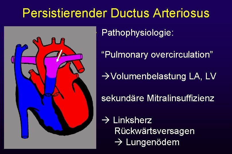 Persistierender Ductus Arteriosus • Pathophysiologie: 160/100 40/20 “Pulmonary overcirculation” Volumenbelastung LA, LV sekundäre Mitralinsuffizienz