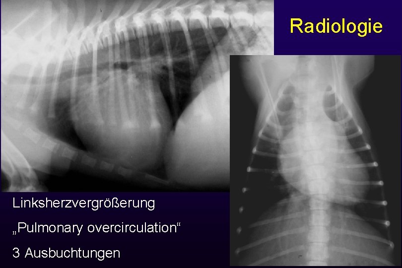 Radiologie Linksherzvergrößerung „Pulmonary overcirculation“ 3 Ausbuchtungen 