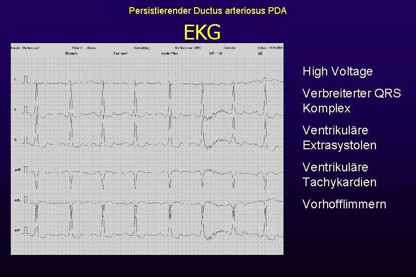 Persistierender Ductus arteriosus PDA EKG High Voltage Verbreiterter QRS Komplex Ventrikuläre Extrasystolen Ventrikuläre Tachykardien