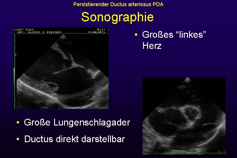 Persistierender Ductus arteriosus PDA Sonographie • Großes “linkes” Herz • Große Lungenschlagader • Ductus