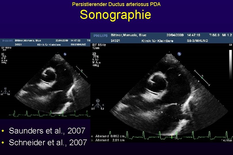 Persistierender Ductus arteriosus PDA Sonographie • Saunders et al. , 2007 • Schneider et