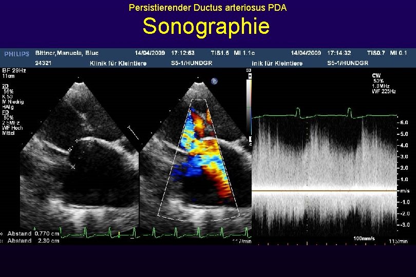 Persistierender Ductus arteriosus PDA Sonographie 