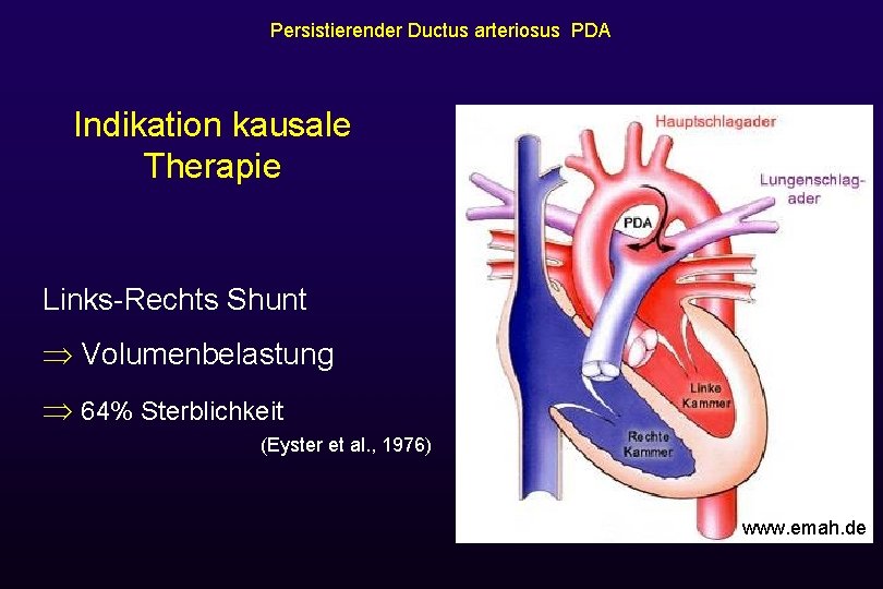 Persistierender Ductus arteriosus PDA Indikation kausale Therapie Links-Rechts Shunt Volumenbelastung 64% Sterblichkeit (Eyster et