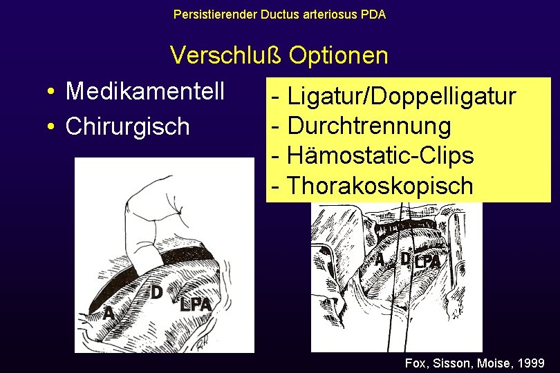 Persistierender Ductus arteriosus PDA Verschluß Optionen • Medikamentell - Ligatur/Doppelligatur Indomethacin, - Durchtrennung •