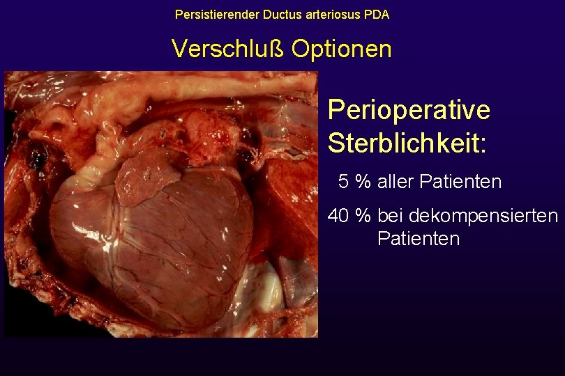 Persistierender Ductus arteriosus PDA Verschluß Optionen Perioperative Sterblichkeit: 5 % aller Patienten 40 %