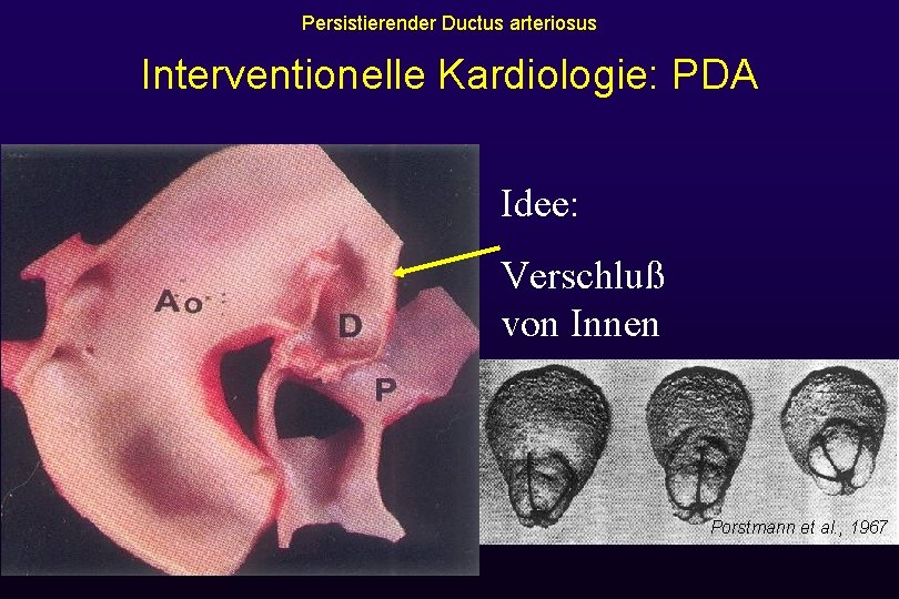 Persistierender Ductus arteriosus Interventionelle Kardiologie: PDA Idee: Verschluß von Innen Porstmann et al. ,