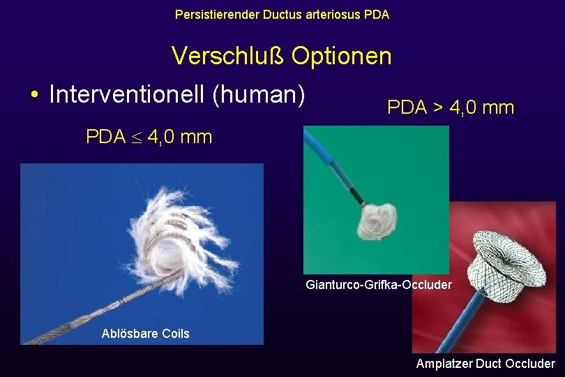 Persistierender Ductus arteriosus PDA Verschluß Optionen • Interventionell (human) PDA > 4, 0 mm