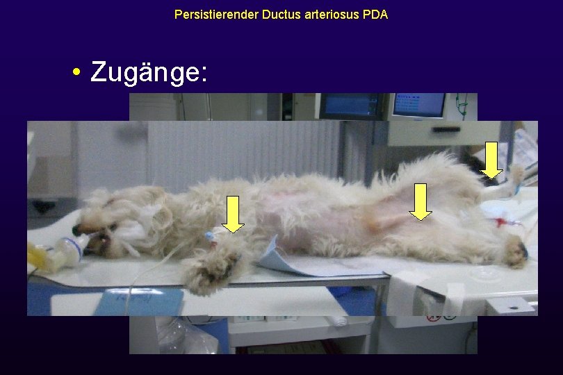 Persistierender Ductus arteriosus PDA • Zugänge: 