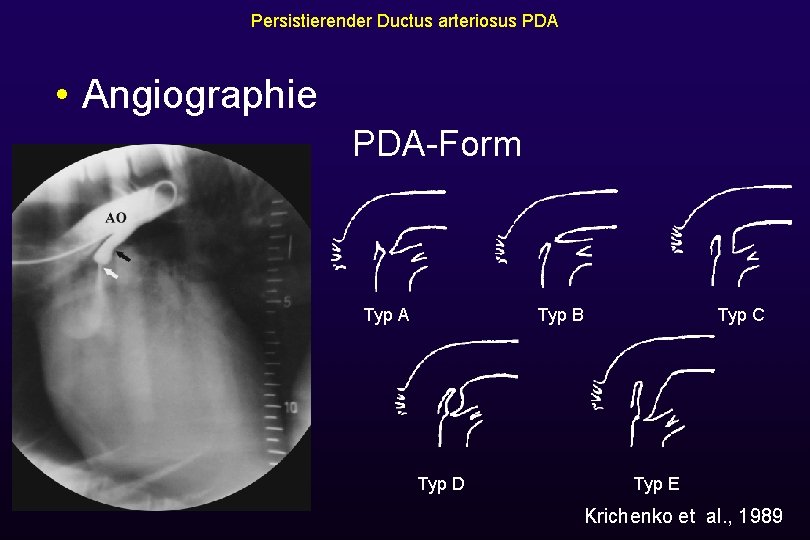 Persistierender Ductus arteriosus PDA • Angiographie PDA-Form Typ A Typ B Typ D Typ