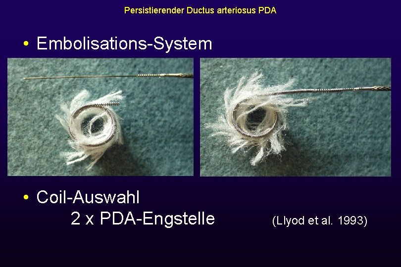 Persistierender Ductus arteriosus PDA • Embolisations-System • Coil-Auswahl 2 x PDA-Engstelle (Llyod et al.