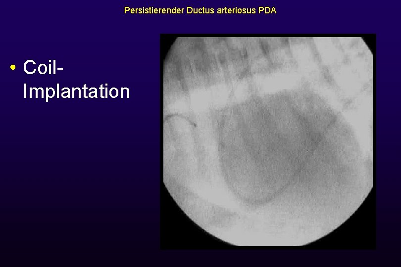 Persistierender Ductus arteriosus PDA • Coil. Implantation 