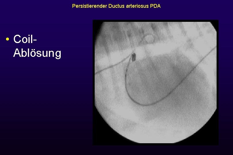 Persistierender Ductus arteriosus PDA • Coil. Ablösung 