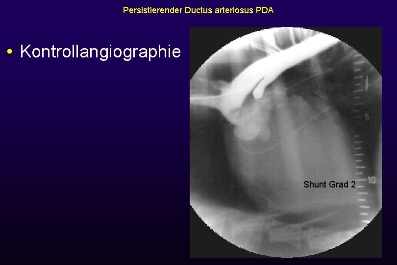 Persistierender Ductus arteriosus PDA • Kontrollangiographie Shunt Grad 2 