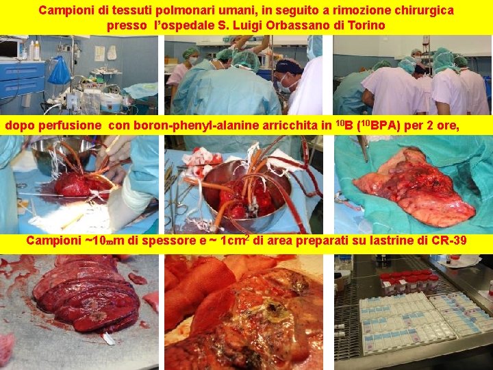 Campioni di tessuti polmonari umani, in seguito a rimozione chirurgica presso l’ospedale S. Luigi