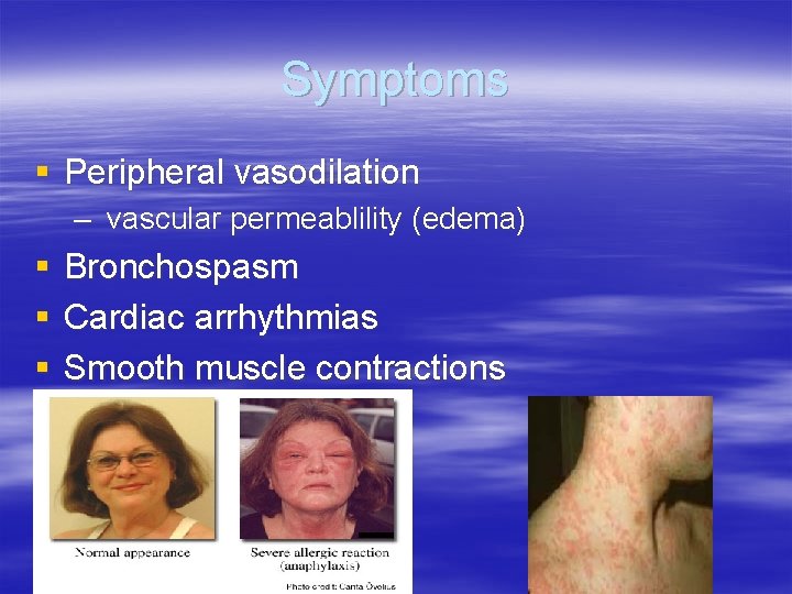 Symptoms § Peripheral vasodilation – vascular permeablility (edema) § § § Bronchospasm Cardiac arrhythmias