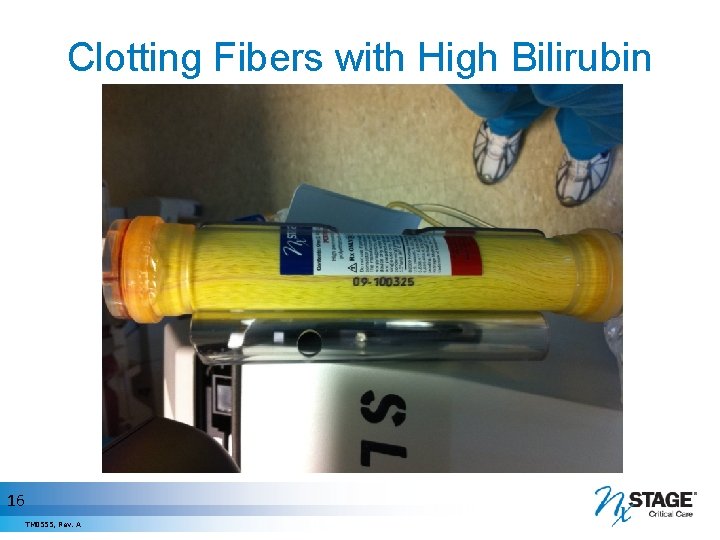 Clotting Fibers with High Bilirubin 16 TM 0555, Rev. A 