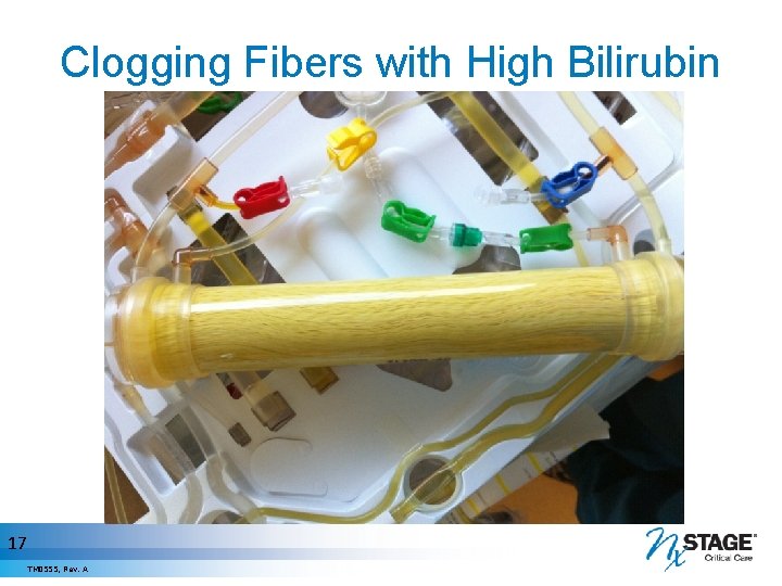 Clogging Fibers with High Bilirubin 17 TM 0555, Rev. A 