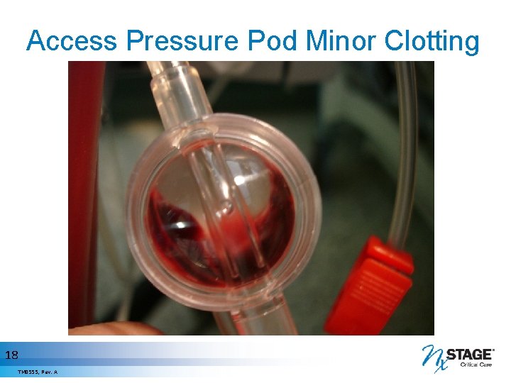 Access Pressure Pod Minor Clotting 18 TM 0555, Rev. A 