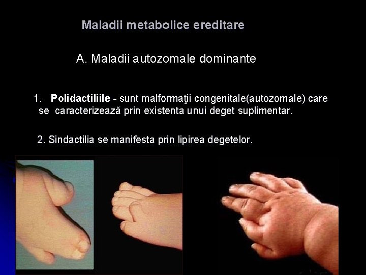 Maladii metabolice ereditare A. Maladii autozomale dominante 1. Polidactiliile - sunt malformaţii congenitale(autozomale) care