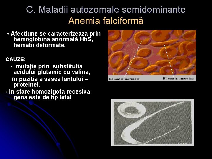 C. Maladii autozomale semidominante Anemia falciformă • Afectiune se caracterizeaza prin hemoglobina anormală Hb.