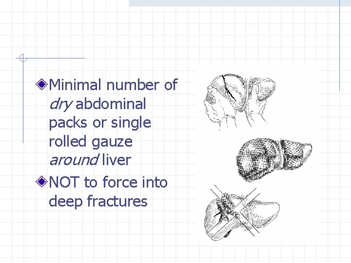 Minimal number of dry abdominal packs or single rolled gauze around liver NOT to