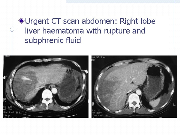 Urgent CT scan abdomen: Right lobe liver haematoma with rupture and subphrenic fluid 