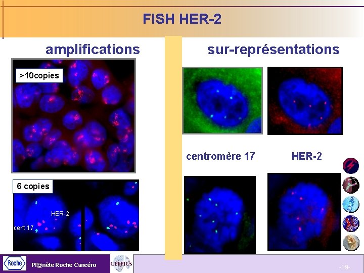 FISH HER-2 amplifications sur-représentations >10 copies centromère 17 HER-2 6 copies HER-2 cent 17