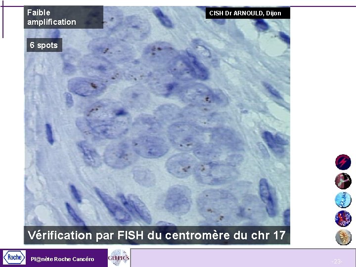 Faible amplification CISH Dr ARNOULD, Dijon 6 spots Vérification par FISH du centromère du