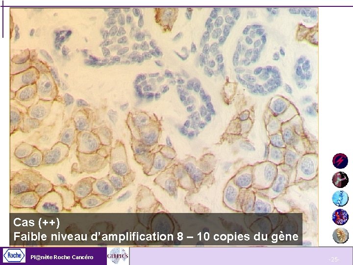 Cas (++) Faible niveau d’amplification 8 – 10 copies du gène Pl@nète Roche Cancéro