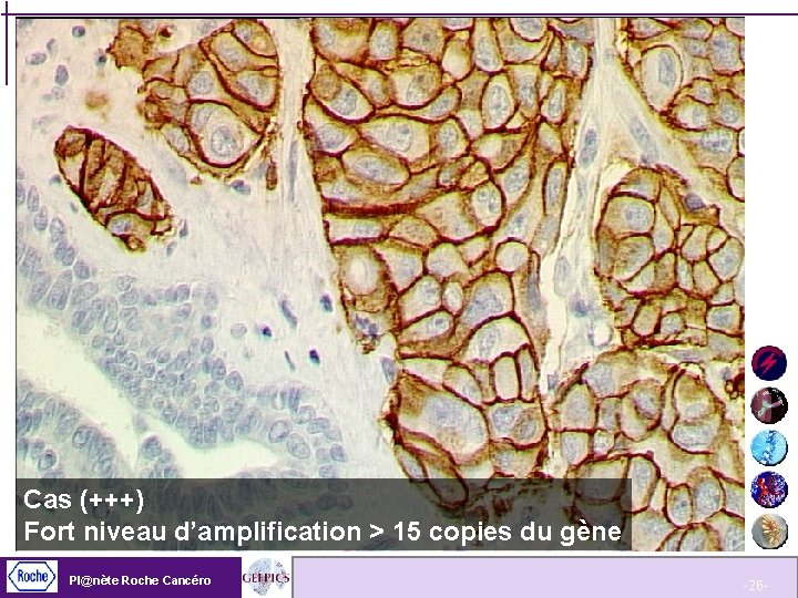 Cas (+++) Fort niveau d’amplification > 15 copies du gène Pl@nète Roche Cancéro -26