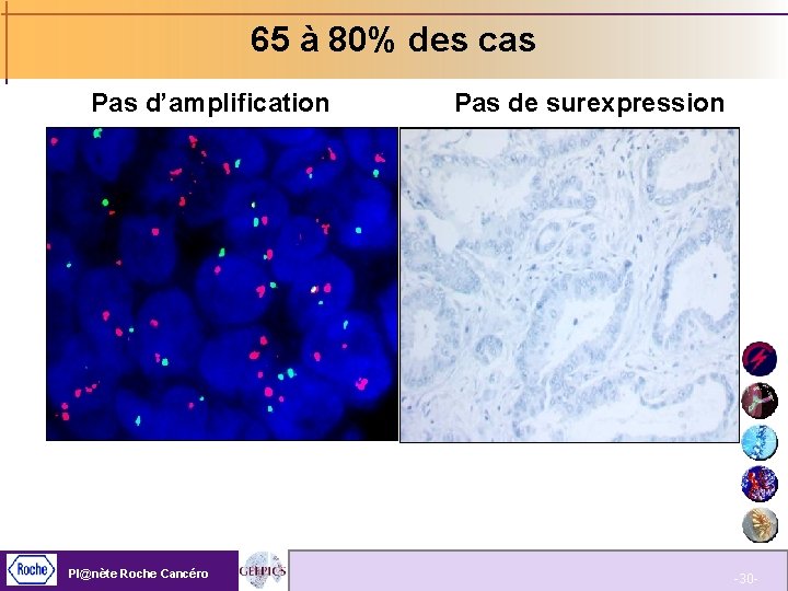 65 à 80% des cas Pas d’amplification Pl@nète Roche Cancéro Pas de surexpression -30