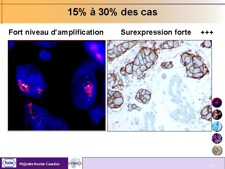 15% à 30% des cas Fort niveau d’amplification Pl@nète Roche Cancéro Surexpression forte +++
