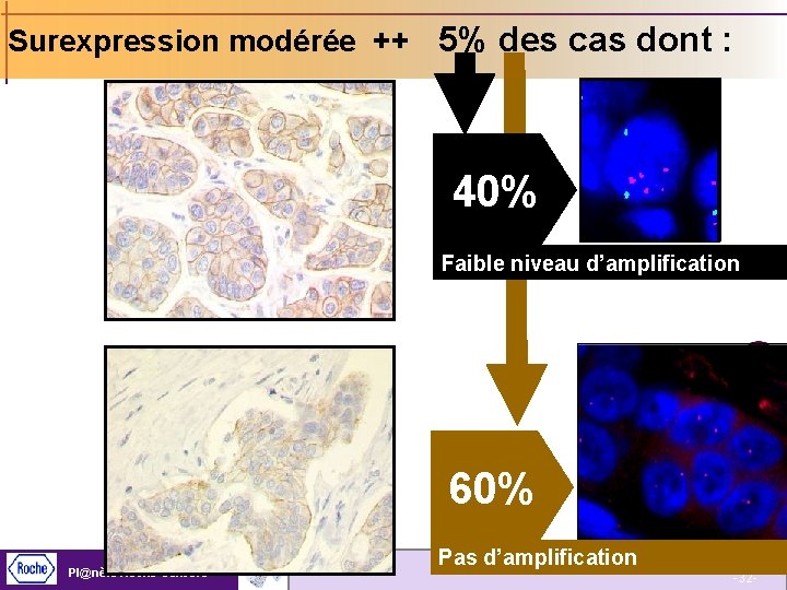 Surexpression modérée ++ 5% des cas dont : 40% Faible niveau d’amplification 60% Pl@nète