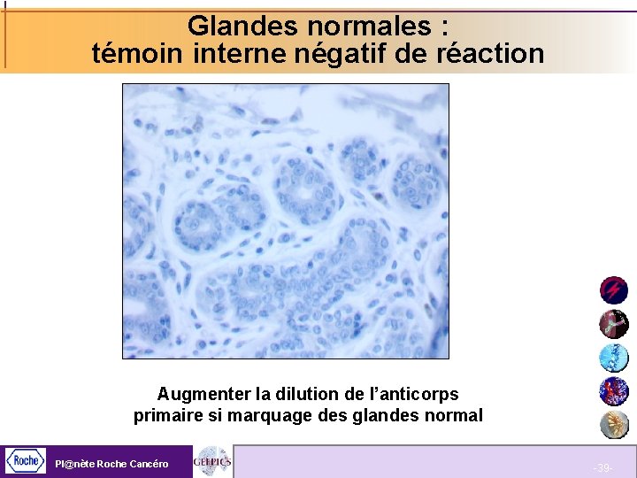 Glandes normales : témoin interne négatif de réaction Augmenter la dilution de l’anticorps primaire