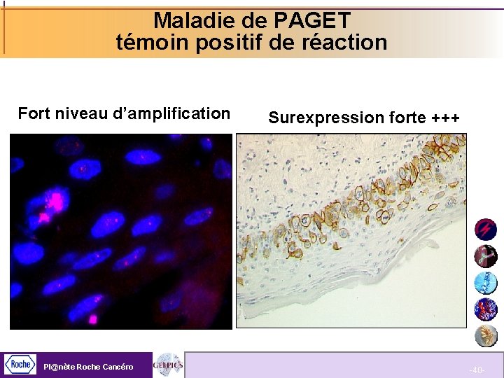 Maladie de PAGET témoin positif de réaction Fort niveau d’amplification Pl@nète Roche Cancéro Surexpression
