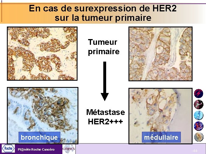 En cas de surexpression de HER 2 sur la tumeur primaire Tumeur primaire Métastase