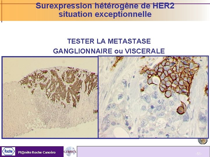 Surexpression hétérogène de HER 2 situation exceptionnelle TESTER LA METASTASE GANGLIONNAIRE ou VISCERALE Pl@nète