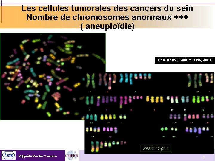 Les cellules tumorales des cancers du sein Nombre de chromosomes anormaux +++ ( aneuploïdie)