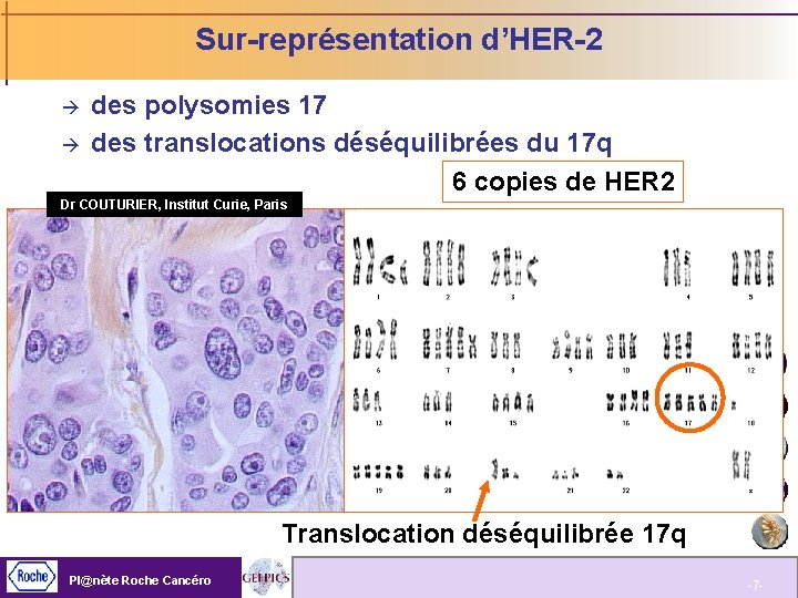 Sur-représentation d’HER-2 des polysomies 17 des translocations déséquilibrées du 17 q 6 copies de