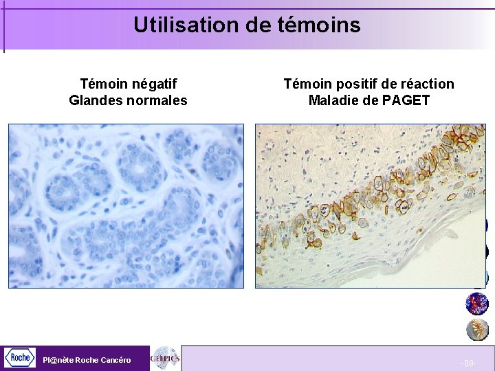 Utilisation de témoins Témoin négatif Glandes normales Pl@nète Roche Cancéro Témoin positif de réaction