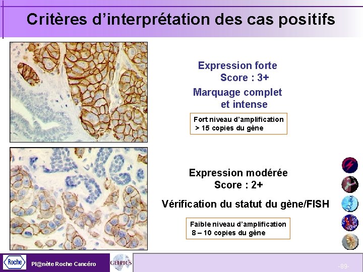 Critères d’interprétation des cas positifs Expression forte Score : 3+ Marquage complet et intense