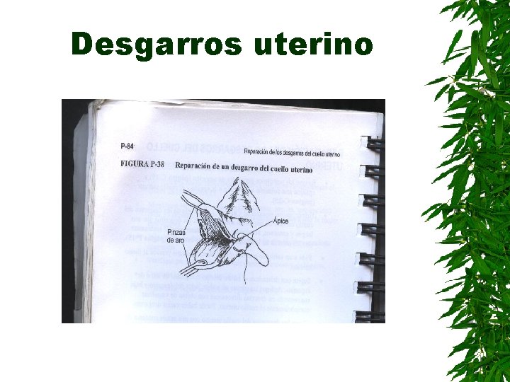 Desgarros uterino 