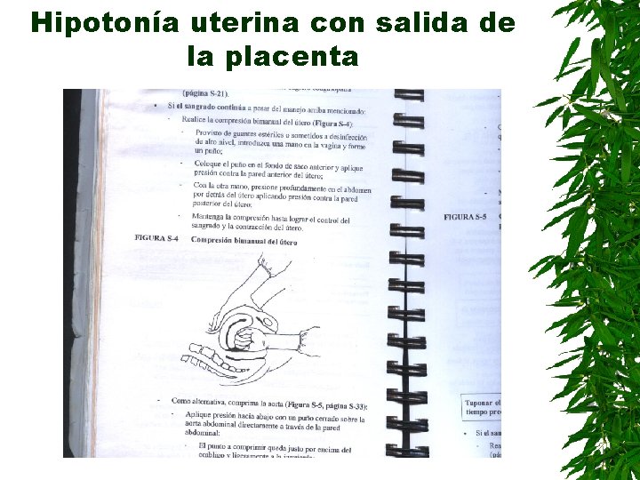Hipotonía uterina con salida de la placenta 