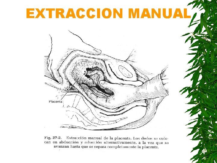EXTRACCION MANUAL 