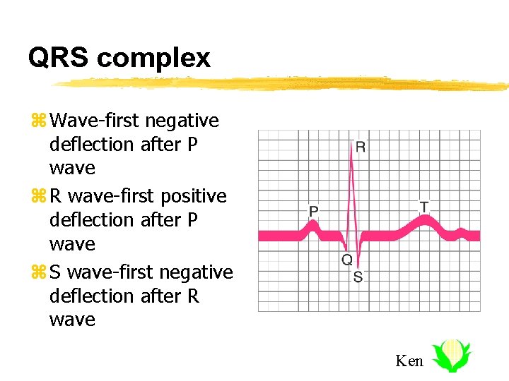 QRS complex z Wave-first negative deflection after P wave z R wave-first positive deflection