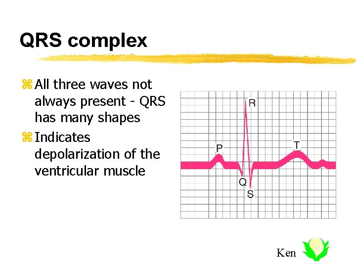 QRS complex z All three waves not always present - QRS has many shapes