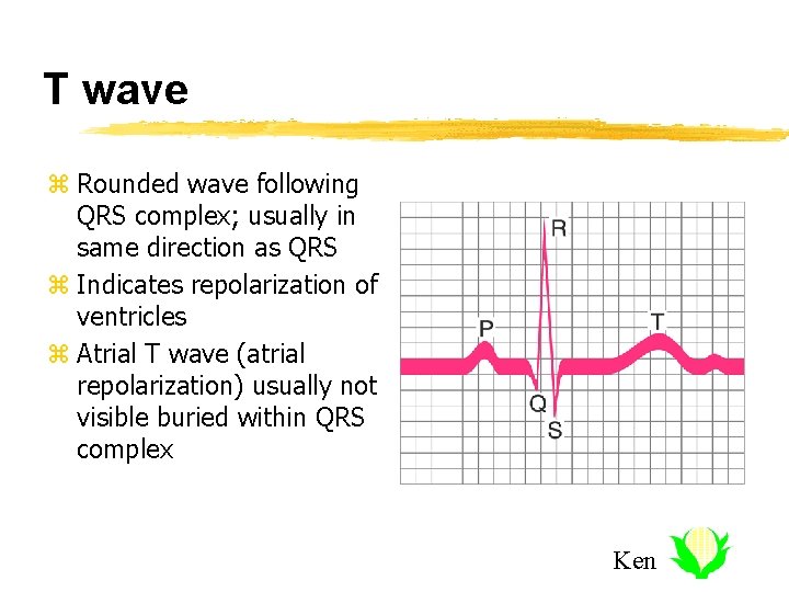 T wave z Rounded wave following QRS complex; usually in same direction as QRS