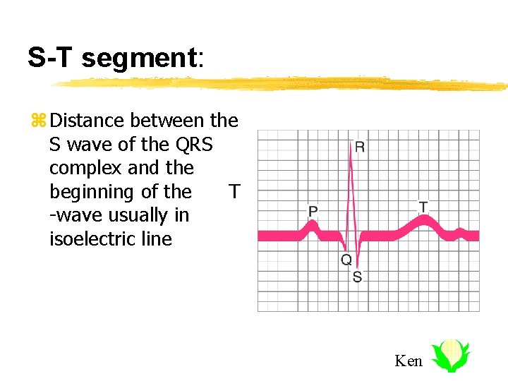 S-T segment: z Distance between the S wave of the QRS complex and the